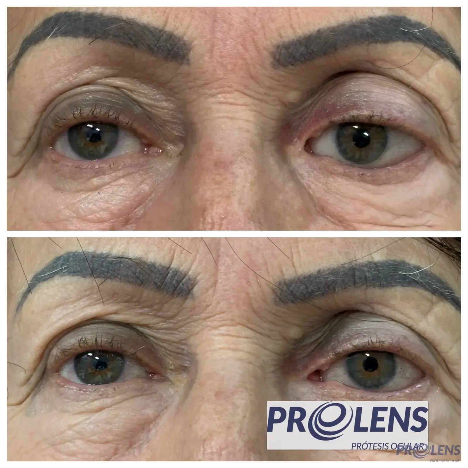 Prótesis ocular personalizada — antes / después