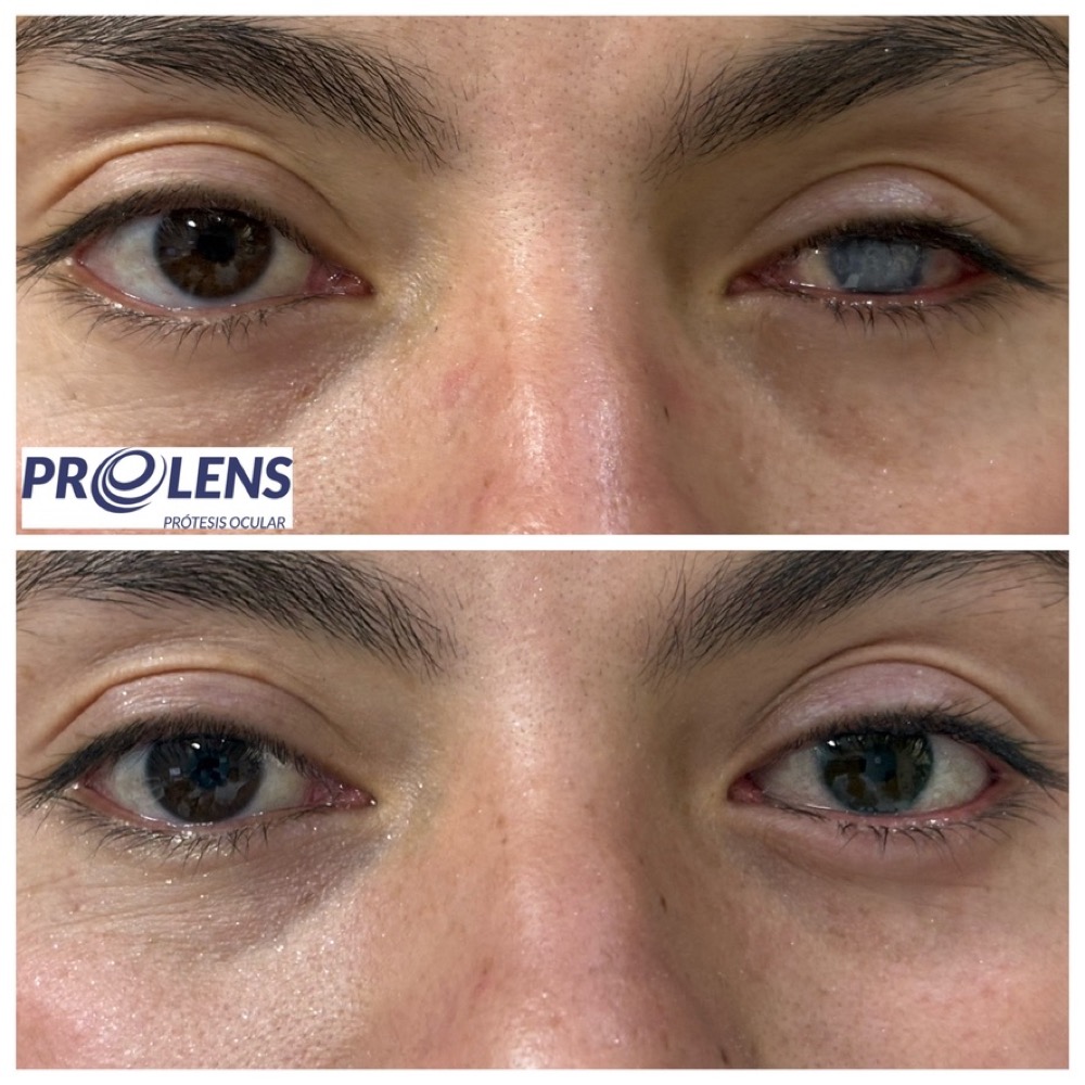 Rehabilitación protésica — antes / después