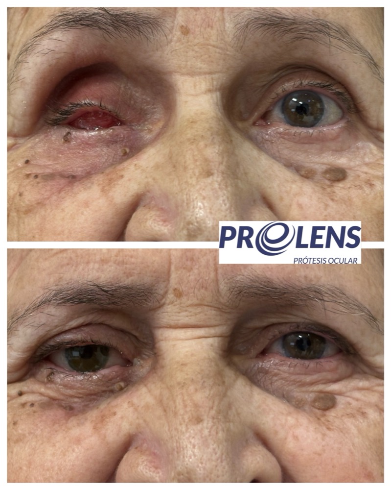 Prótesis ocular personalizada