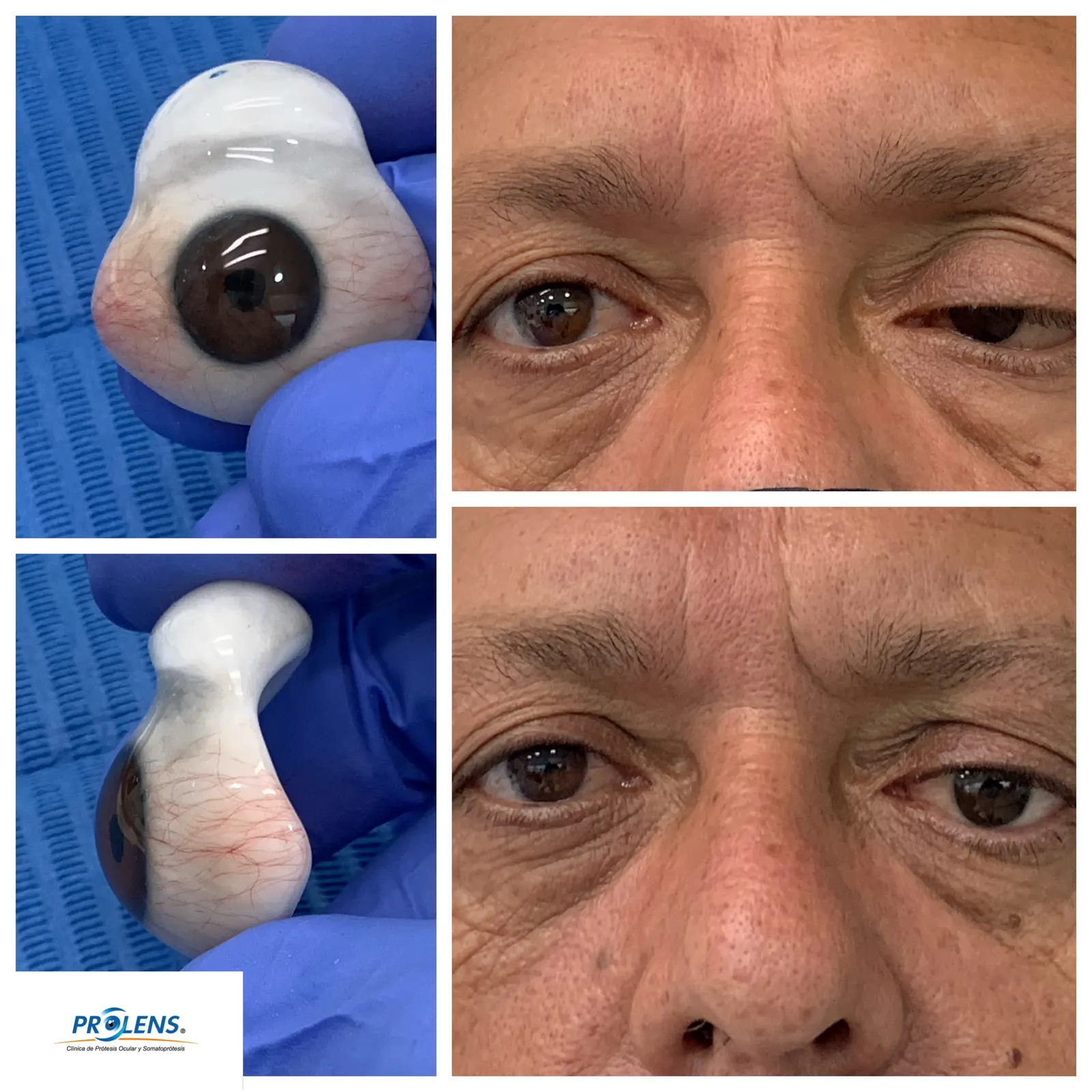 Prótesis ocular personalizada
